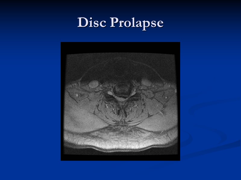Disc Prolapse